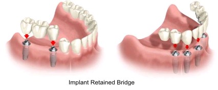 Dental Implant Retained Bridge and Denture