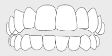 Invisalign correctable - open bite