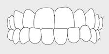 Invisalign correctable - underbite